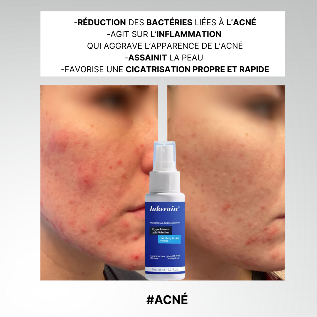 L'Acide Hypochloreux, une peau enfin nette