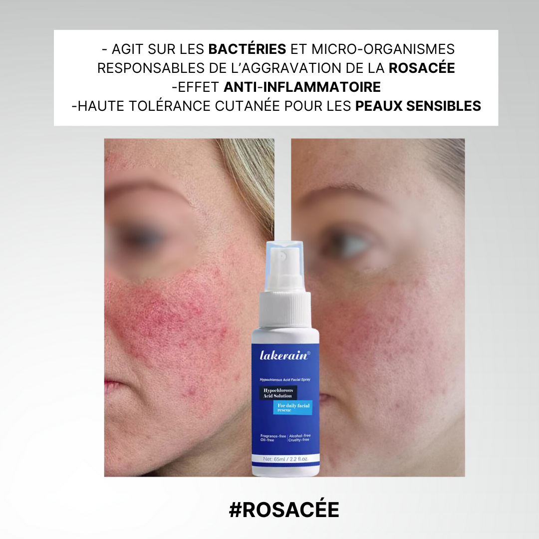 L'Acide Hypochloreux, une peau enfin nette