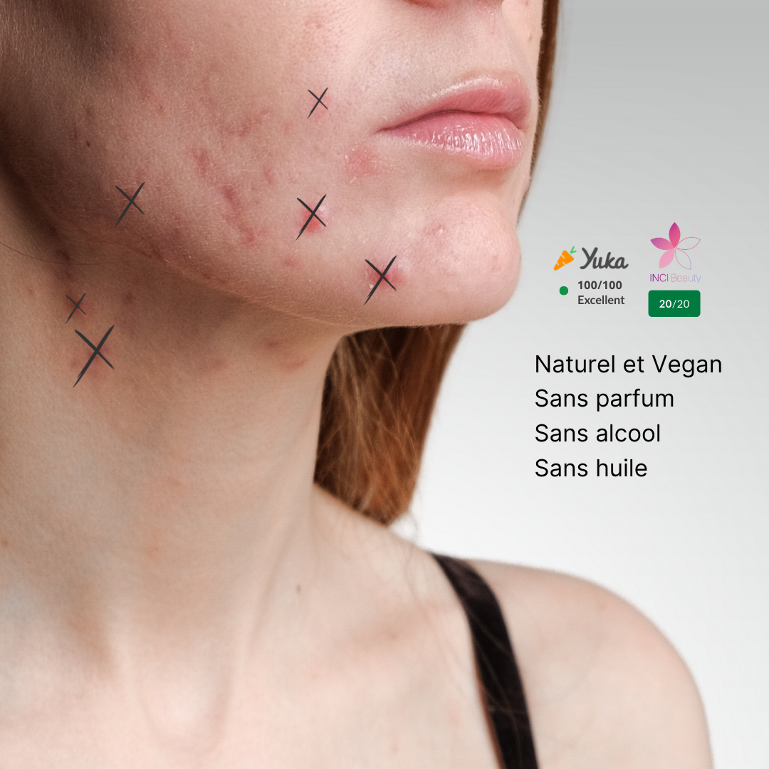 L'Acide Hypochloreux, une peau enfin nette